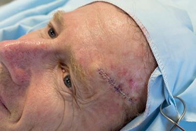 Skin cancer surgery in a mans face.