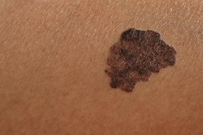 Person with Melanoma on skin
