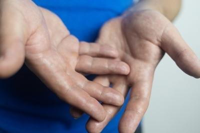 Illustration of Excessive Sweating