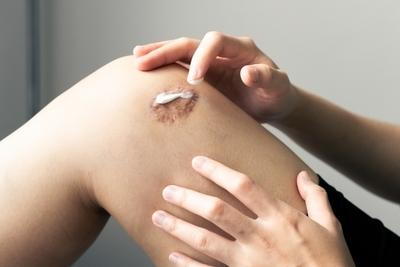 Person put an ointment on a big scar on leg