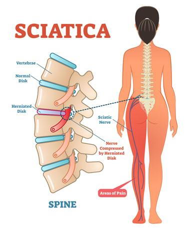 Sciatica Pain Can Radiate To The Knee: Injury Medical Chiropractic