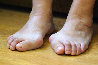 Close-up-of-feet-with-bunions-on-wooden-floor
