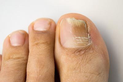Illustration-of-fungal-toenail-with-white-floor.