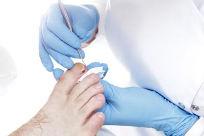 Medical professional providing care for infected ingrown toenail