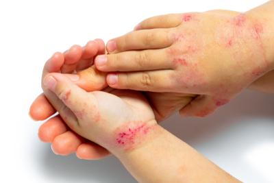 Child skin infected with Eczema conditions