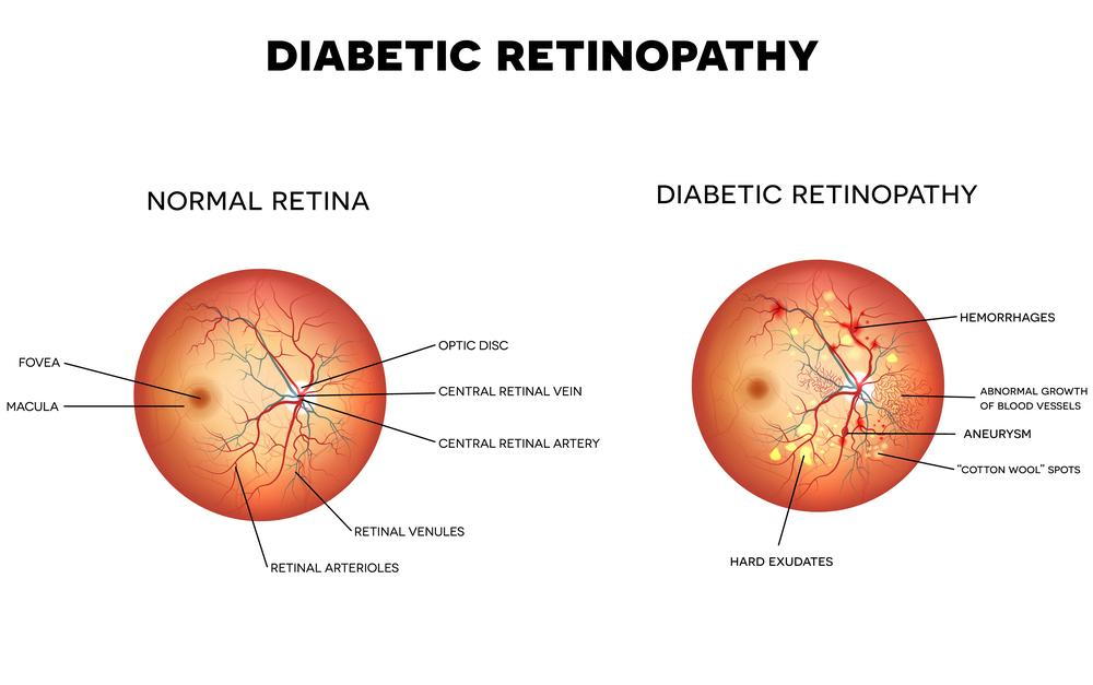 kezelése retina peeling diabetes)
