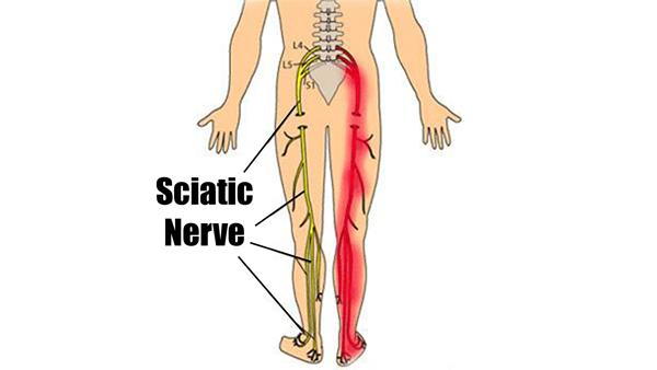 Sciatica and Sciatic Nerve Pain
