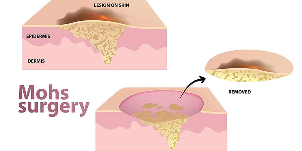 Mohs-Micrographic-Surgery-for-Melanoma