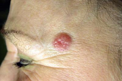 Illustration-of-Basal-Cell-Carcinoma-in-skin.