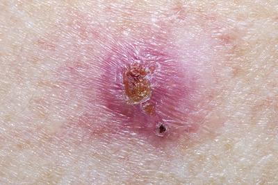 Skin-with-Basal-Cell-Carcinoma-condition