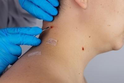 Sample-Illustration-of-Surgical-Excision-in-back-of-patient.