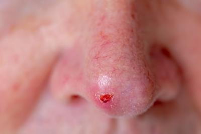 Basal-Cell-Carcinoma-in-nose-of-a-man