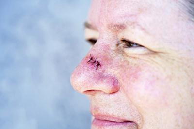 Senior man after the procedure of Skin cancer removal (MOHS)