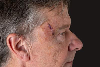 Patient after Mohs procedure for skin cancer near his temple