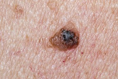 Melanoma on skin of a person
