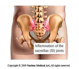 si joints inflammation