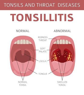 Operate now: Tonsil Surgery 