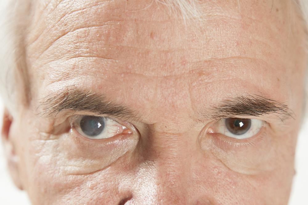 Elderly Man With Cataract Right Eye