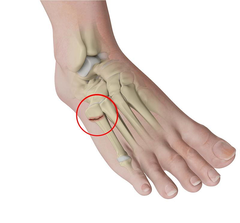 pain on the side of the foot