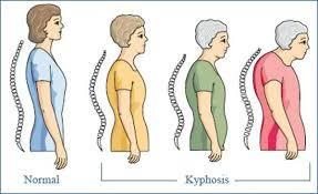 Poor posture linked to decreased lifespan.