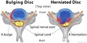 The Difference Between Bulging and Herniated Discs.