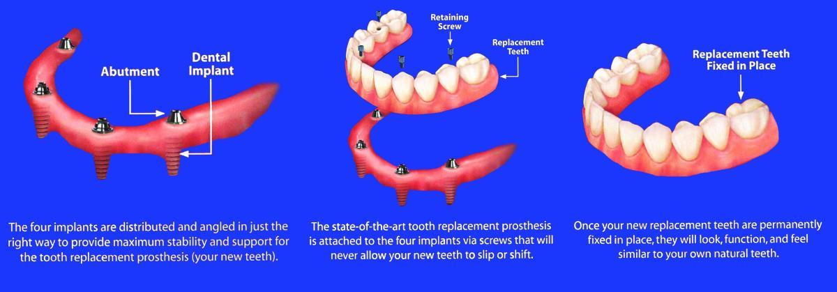 Implant Dentures