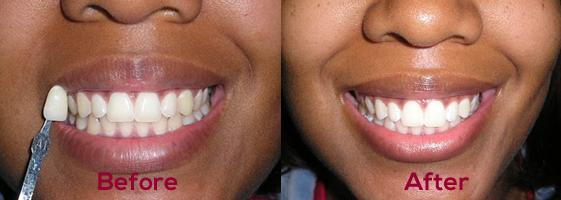 Teeth Whitening For Whiter Teeth And A Beautiful Smile