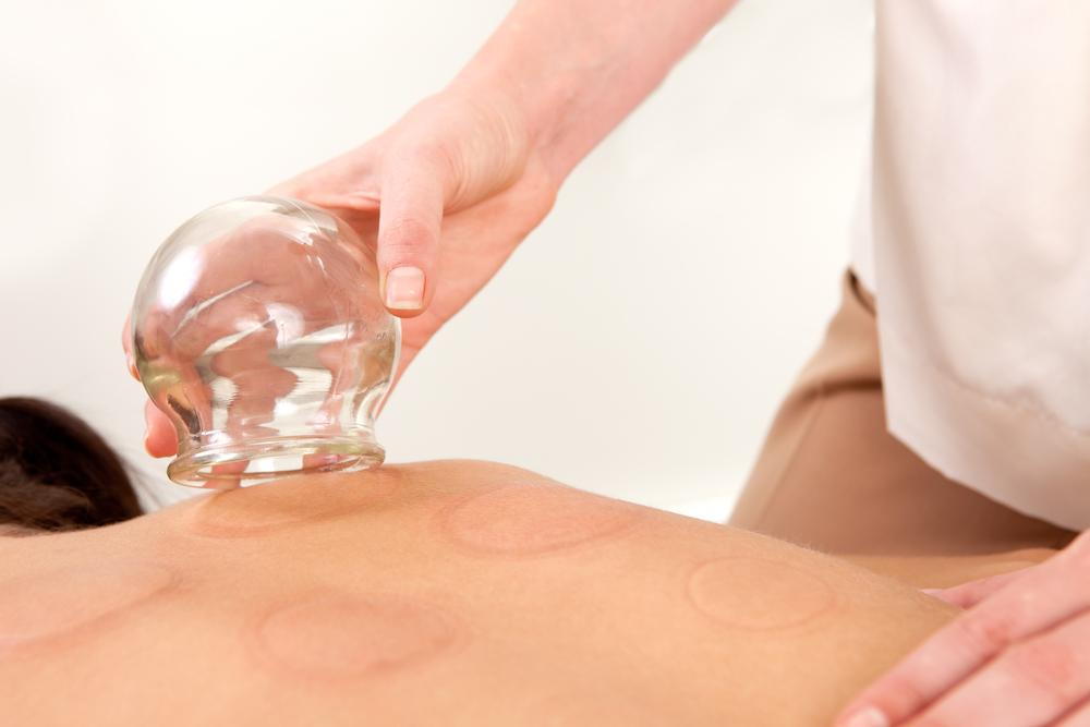 Chiropractor performing cupping therapy on patient
