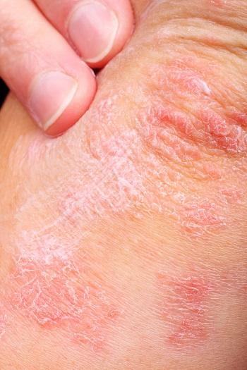 Skin Rash