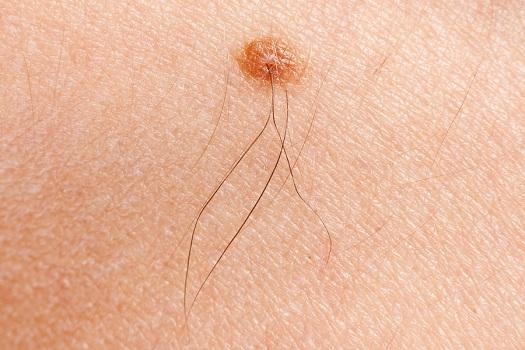 The Early Signs Of Skin Cancer