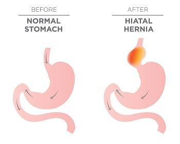 What to Do if You Have a Hernia