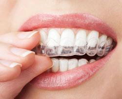 Clear Invisalign Braces