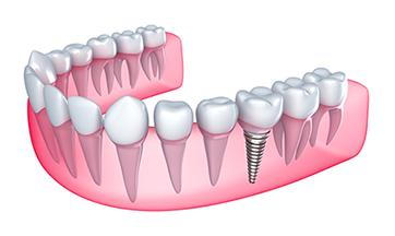 Dental Implants Cartoon