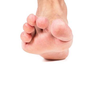foot with hammertoe