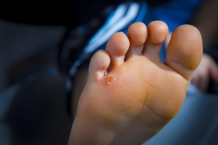 callus on the bottom of a foot