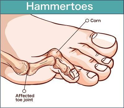 What is a hammertoe? Causes, symptoms and treatment - OMA - Oh My