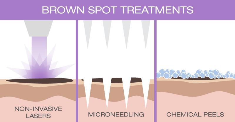 Brown spot treatments