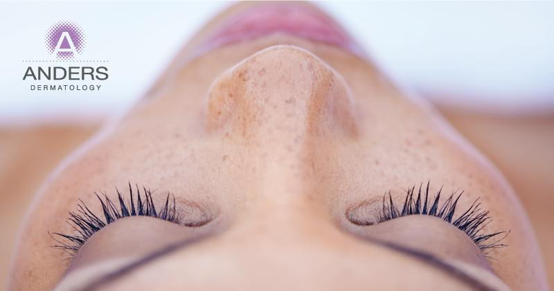 eyelash growth treatment | Anders Dermatology