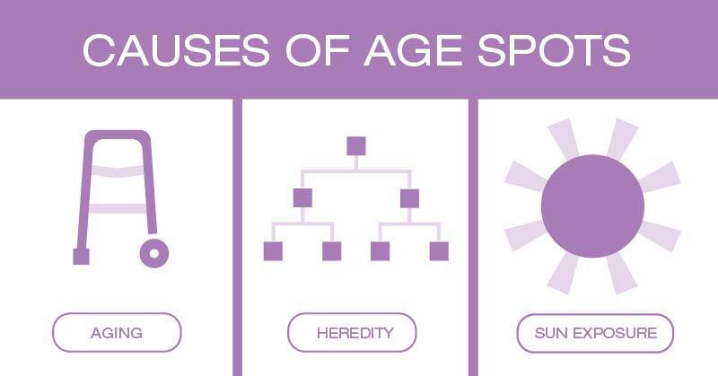 Age Spots: Causes and Treatment