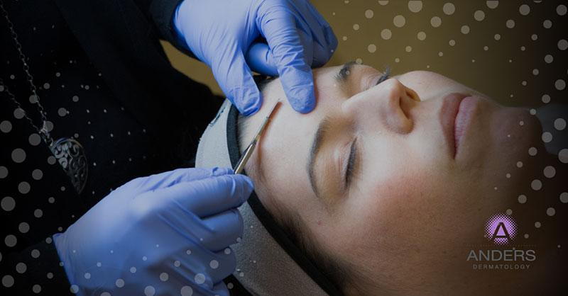 The Bare Facts About Dermaplaning - Anders Dermatology