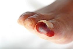 Emergency Toe Injury