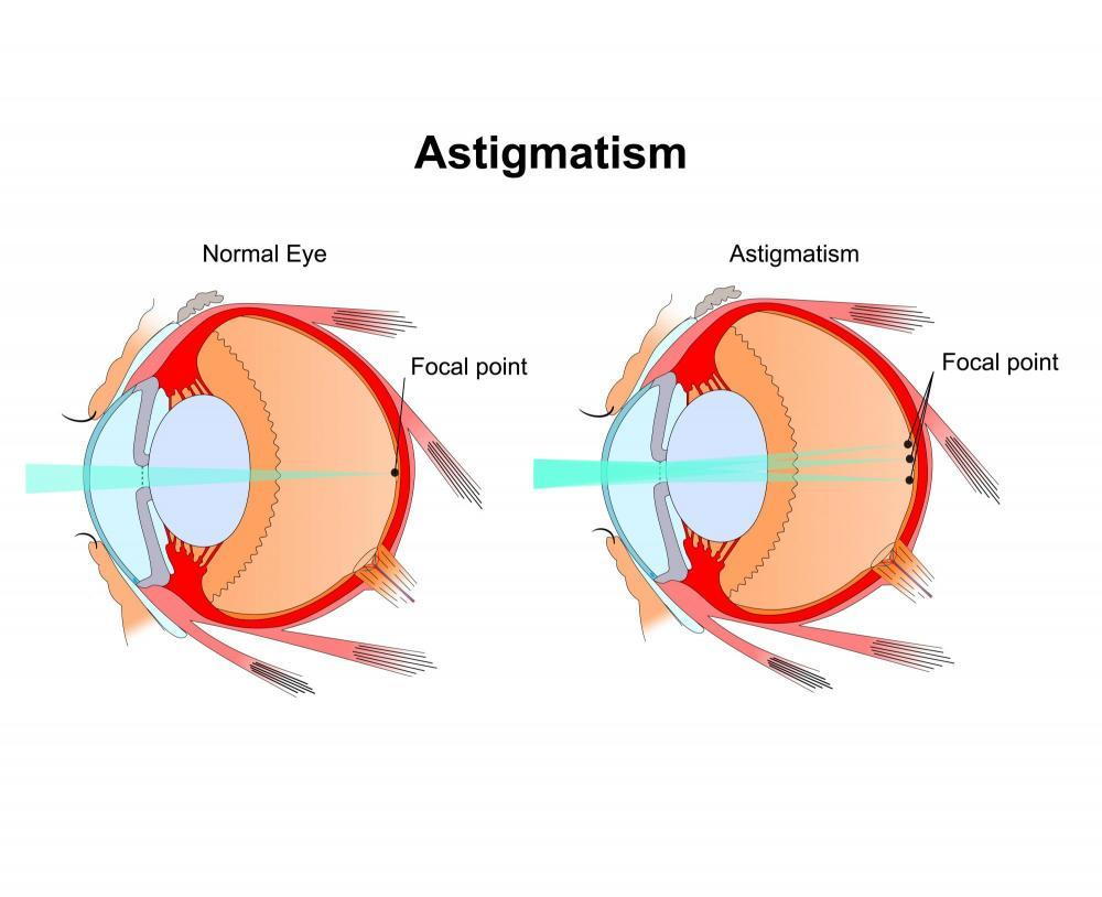 image of astigmatism in eye