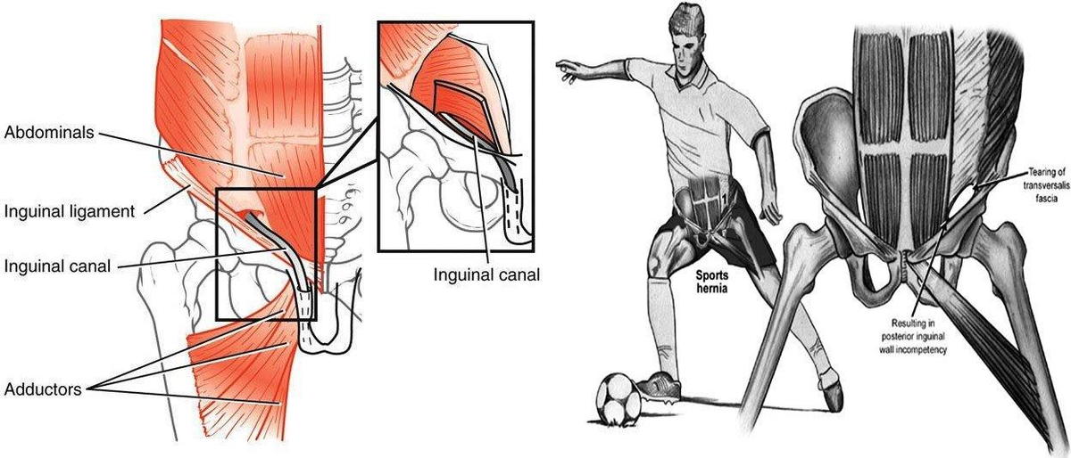Sports Hernia Symptoms, Tests and Treatment
