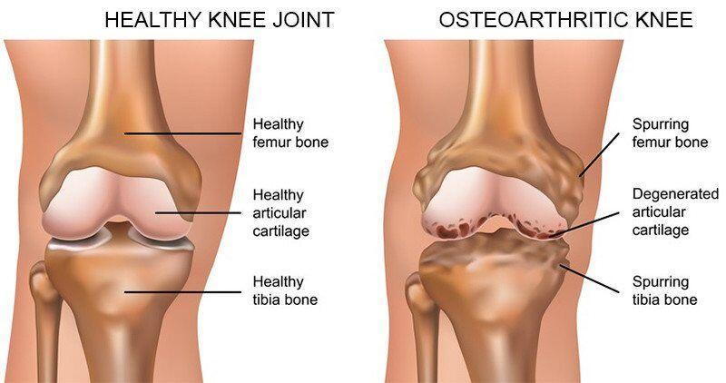 Example of healthy knee vs. osteoarthritic knee