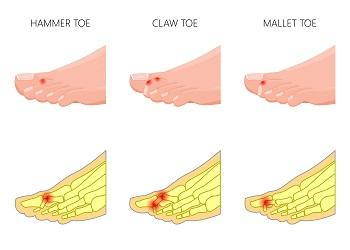 Mr Miles Callahan  Claw and Hammer Toes