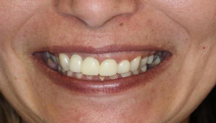 Unilateral Gummy Smile - Dr Najafi Esthetic Periodontist