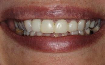Asymmetrical gummy smile treatment by Dr Najafi