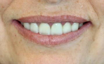 After Veneers & Lip Repositioning (LipStat) by Dr Najafi