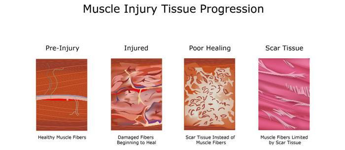 tissue progression