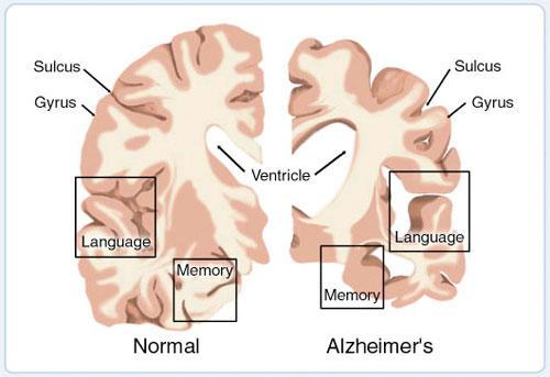 alzheimer's-disease